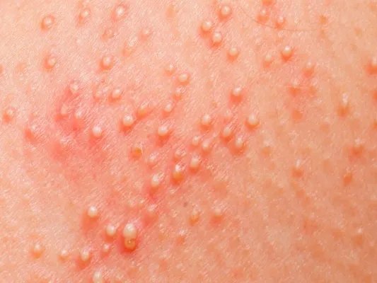 新加坡遇上史上最严重登革热疫情,轻型登革热似感冒要注意!