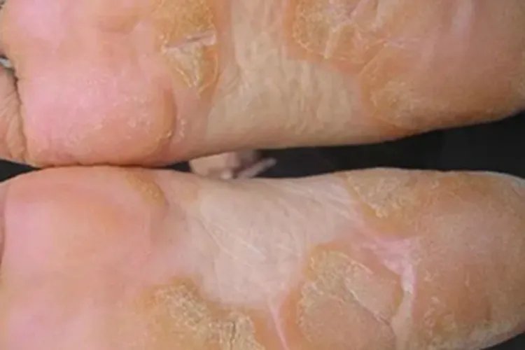 塞扎里综合征脚部皮肤粗糙图片