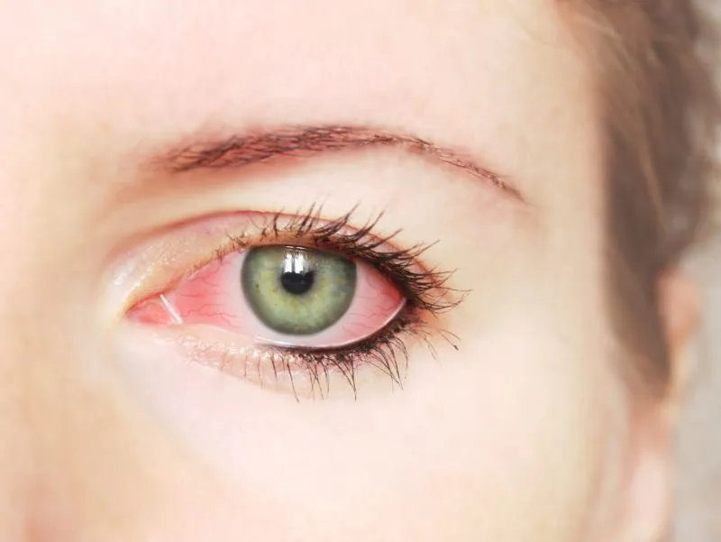 红眼病早期症状有哪些