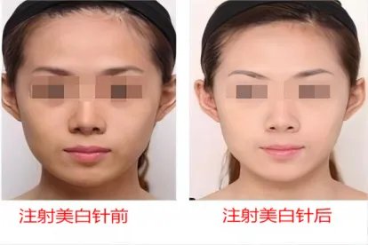 美白针效果图前后对比
