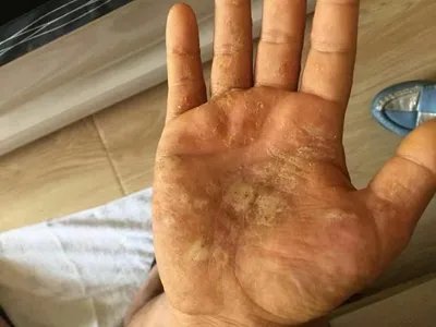 手部湿疹手掌水疱图片