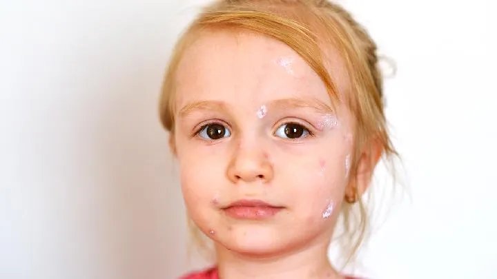 最有效的治疗痤疮偏方