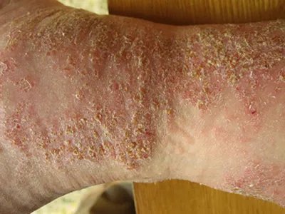 皮肤过敏红肿手腕黄痂图片