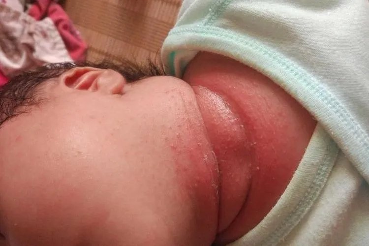 婴儿常见皮肤病配图