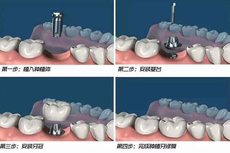 种植牙详细步骤图解