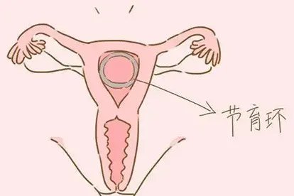 节育环放在哪个位置图解