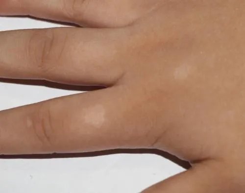 手指关节褶皱处变白图片