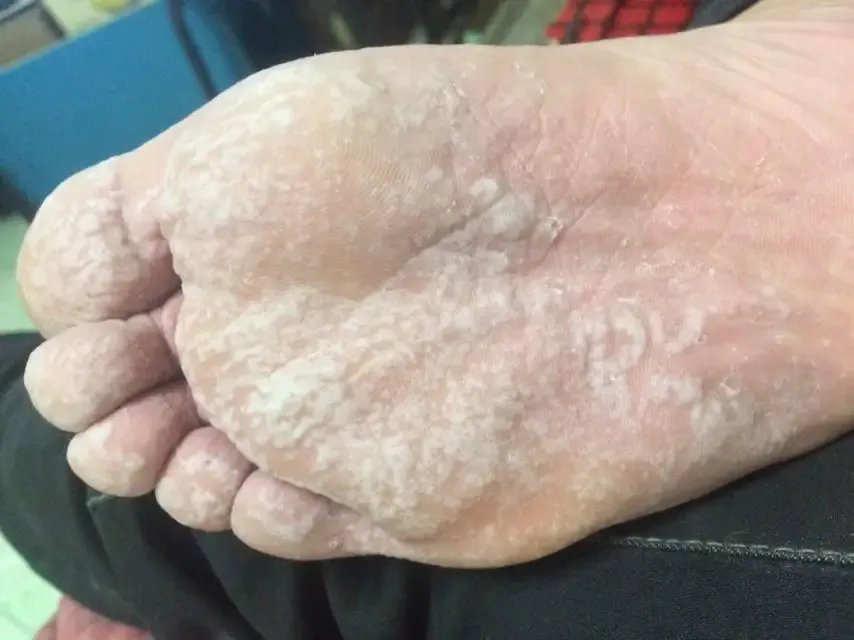 脚底板发白恶臭照片