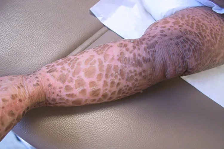 腿上有鱼鳞图片