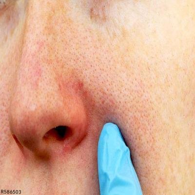 毛孔粗大堵塞怎么办