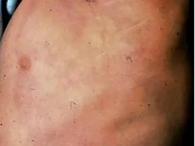 Pasini-Pierni进行性特发性皮肤萎缩红斑图片