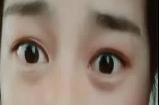 割双眼皮后的效果图片