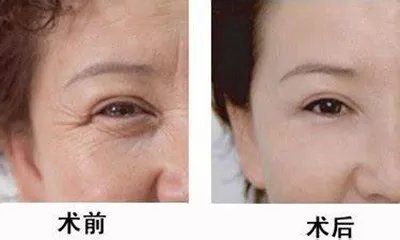 玻尿酸原液多少钱一瓶