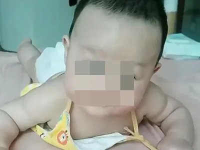 新生儿佝偻病症状图片