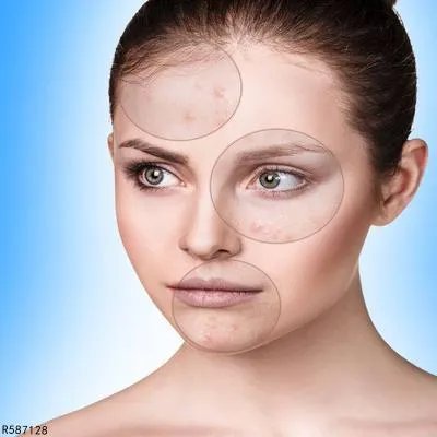 女人额头长痘痘原因有哪些