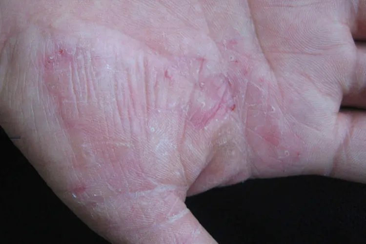 水疱型手癣图片