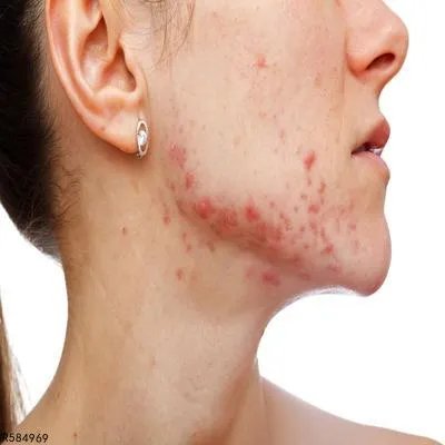 痤疮的西医治疗方法有哪些