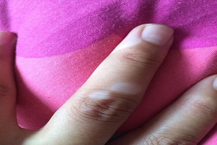 手指关节褶皱处变白图片