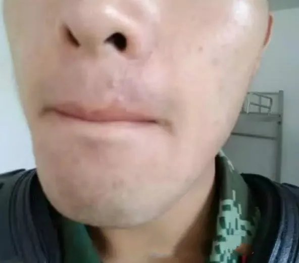 激光去粉刺价格多少