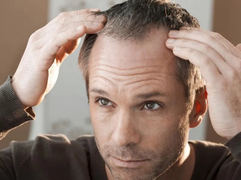 侧柏叶治脱发是否有效