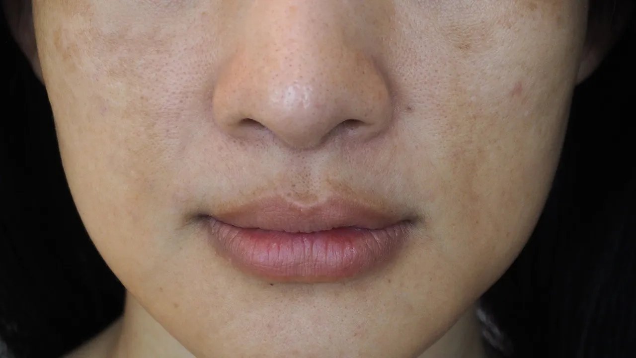 白醋祛斑怎么样