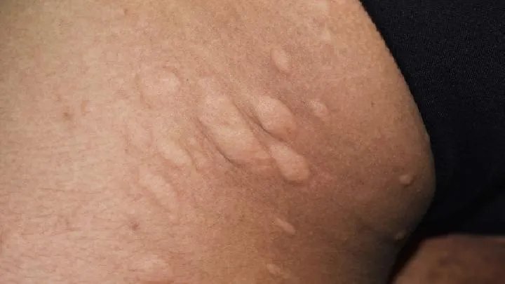 皮肤色斑怎么办呢