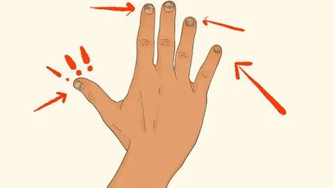 灰指甲容易传染吗