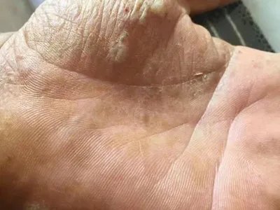 手部湿疹手掌水疱图片