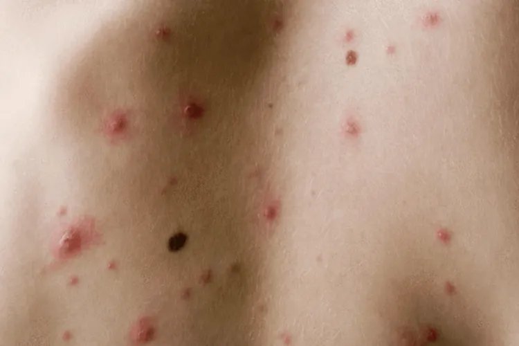 白血病小红点特征图