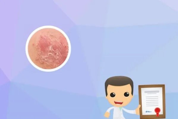 牛皮癣有偏方大全