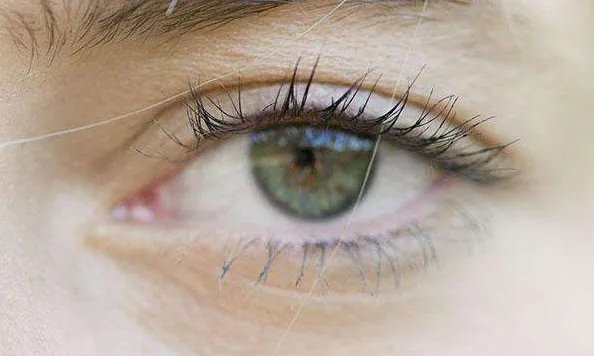 北京开内眼角手术怎么样