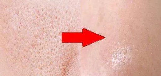 面部毛孔大怎么办