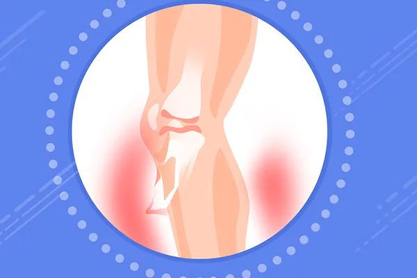 骨折吃什么补钙