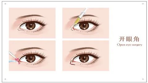开眼角手术痛吗