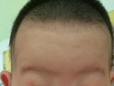 新生儿佝偻病症状图片