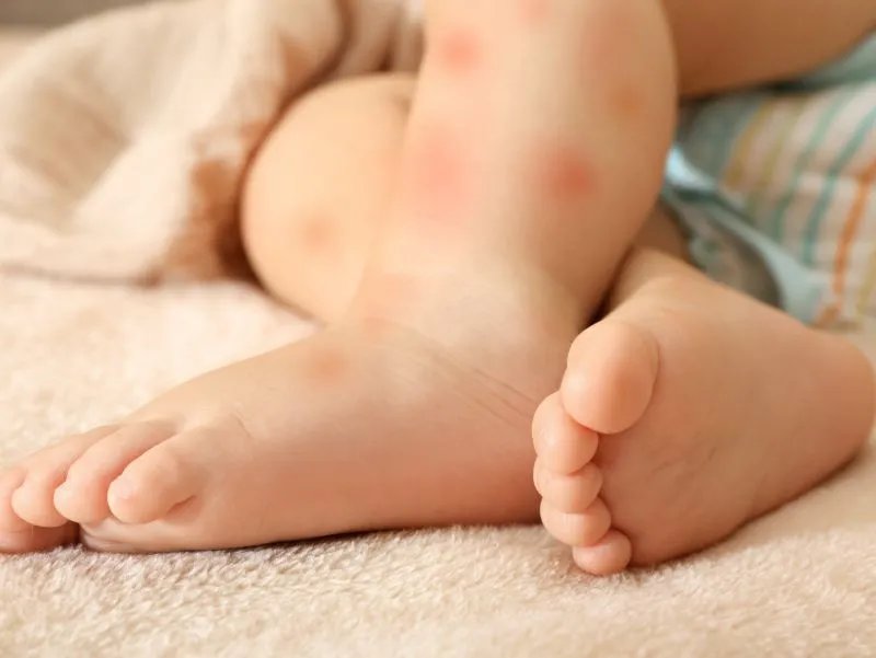 宝宝脸上过敏怎么办