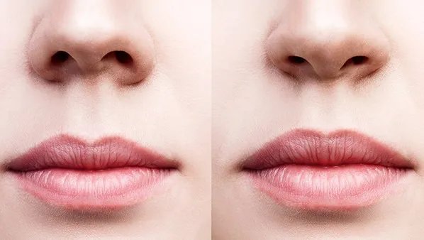 鼻翼缩小手术效果好吗