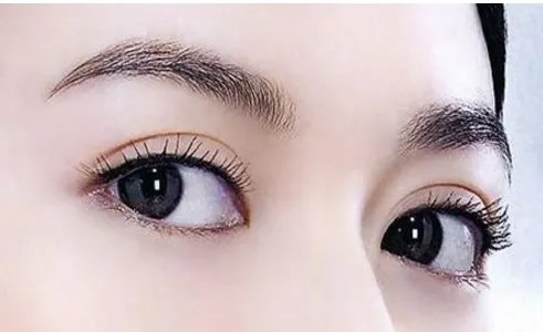 重庆做双眼皮价钱