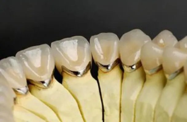 镍铬合金烤瓷牙危害