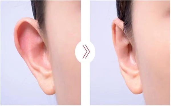 做招风耳手术多少钱