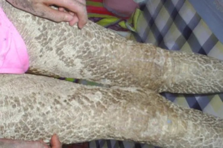 腿上有鱼鳞图片