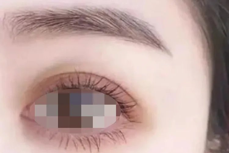 双眼皮类型及图片大全