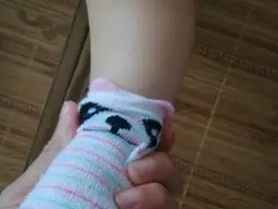 新生儿佝偻病症状图片