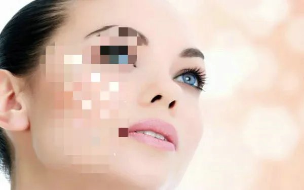 如何去痘印和痘疤