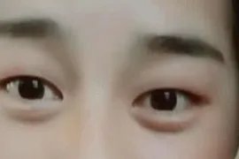 割双眼皮后的效果图片