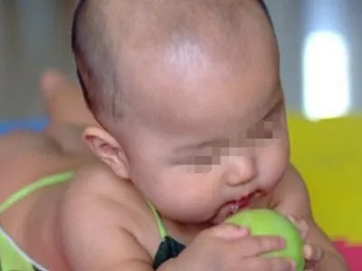 新生儿佝偻病症状图片