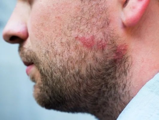 光子嫩肤去红血丝效果