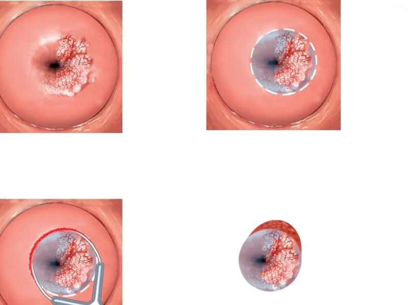腹膜恶性间皮瘤的病因