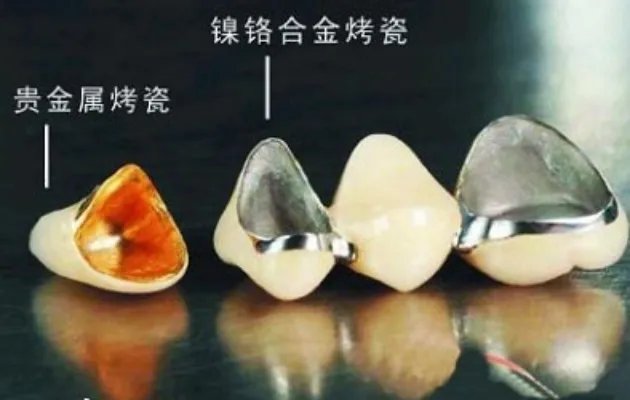 镍铬合金烤瓷牙危害