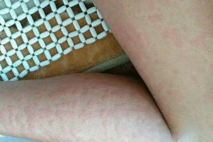 皮麻疹是什么症状图片